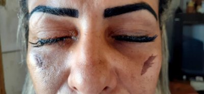 Mulher sofre lesões nos olhos após colocar cílios postiços em clínica de estética...