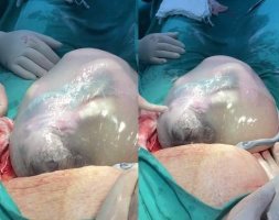 Parto raro de gêmeos prematuros é realizado em Vilhena e comove equipe médica; veja o...