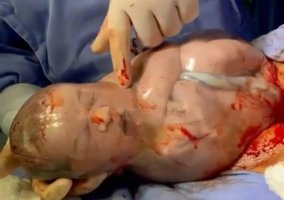 Bebê nasce sem estourar bolsa amniótica em Vilhena e vídeo viraliza na internet