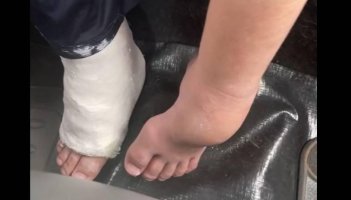 Criança de 12 anos tem o pé engessado 