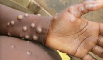 Rondônia registra seis notificações de Mpox