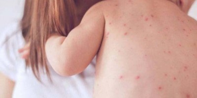 Rondônia confirma primeiro caso de sarampo desde 1999