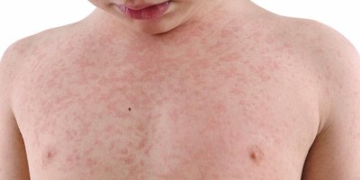 Surto de sarampo já faz vítimas em Rondônia e Amazonas