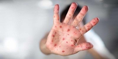 Brasil tem 1.100 casos confirmados de sarampo