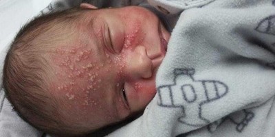 Bebê de 17 dias contrai herpes após beijo de adulto