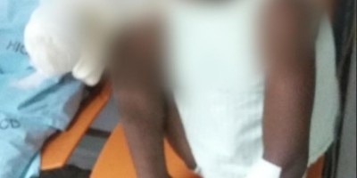 Menino de 9 anos perde a mão após rojão explodir, em RO