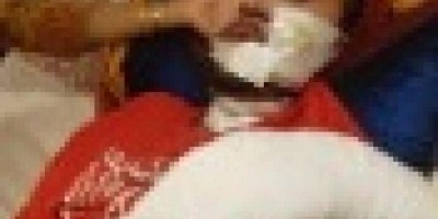 Celular explode e queima rosto e braço de homem