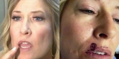 Mulher descobre que espinha acima do lábio era um câncer