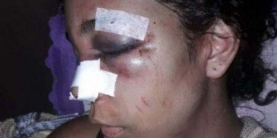 Mulher é agredida pelo ex com martelo e tem nariz quebrado