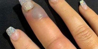 Mulher quase perde o dedo por infecção após manicure