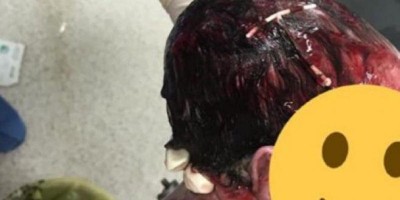 OPS, FALHOU! Bebê nasce com DIU enrolado no cabelo
