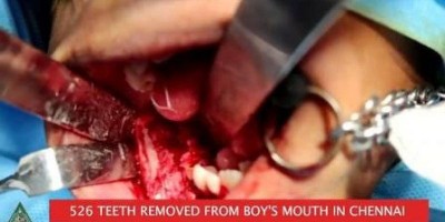 Vídeo: Médicos retiram 526 dentes de paciente de 7 anos