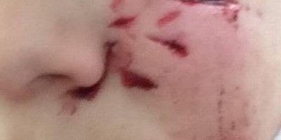 Bebê de 1 ano é atacado por cão e sofre hemorragia