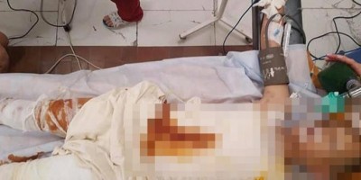 CRUELDADE: Adolescentes ateiam fogo em menino de 8 anos