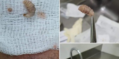 Paciente no Acre tem larva retirada da perna
