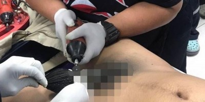 Jovem fica com pênis preso em cano por 5 dias