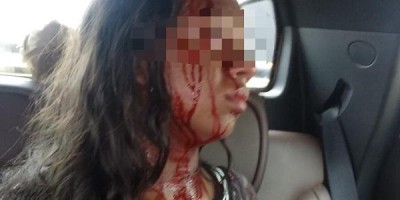 Cachorro ataca a própria dona no meio da rua e é salva pelo vizinho