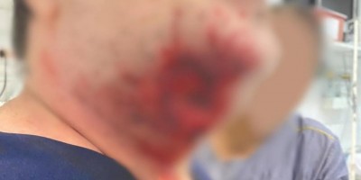 Paciente surta, arranca pedaço de pescoço de médico com mordida e quebra portas de...