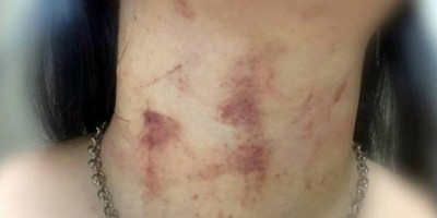 Marido agride e tenta matar mulher estrangulada durante bebedeira