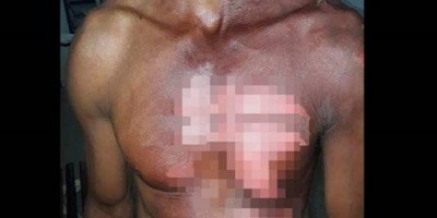 Marido é recebido com óleo fervendo ao chegar em casa bêbado