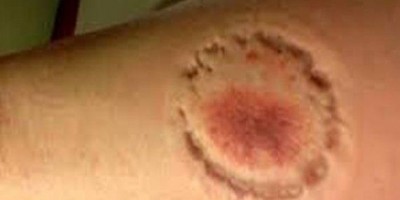 Ex-marido ataca mulher com mordidas e tenta matá-la envenenada dentro de casa