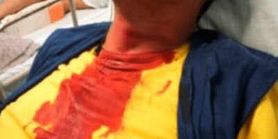 Motociclista sofre corte no rosto causado por linha de pipa com cerol em Rolim de Moura