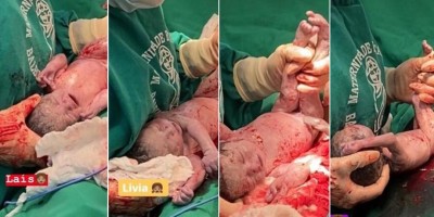 Mãe que esperava trigêmeas descobre 4ª filha 'surpresa' durante o parto no Amazonas