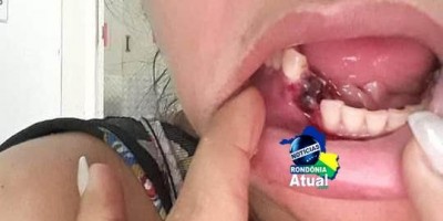 Mulher é espancada em Ji-Paraná e tem dente e maxilar quebrados por agressor