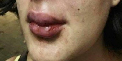 Mulher tem dente quebrado a pancadas ao encontrar ex-marido em bar
