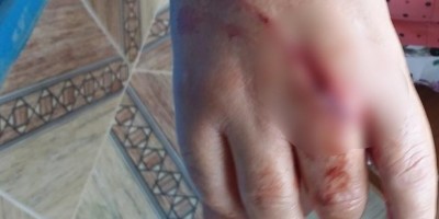 Marido enciumado corta mão da esposa com facão e ainda a agride com socos em Ariquemes