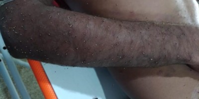 Homem é atendido em estado grave após levar mais 2 mil ferroadas de abelha em Ariquemes