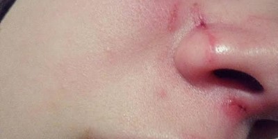 Mulher é socorrida após ter nariz fraturado pelo irmão por causa de um pedaço de bolo