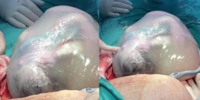 Parto raro de gêmeos prematuros é realizado em Vilhena e comove equipe médica; veja o...