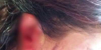 Homem arranca parte de orelha da ex-mulher com mordidas