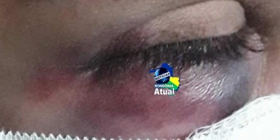 Por ciúmes, jovem é agredida pelo ex-namorado em Ji-Paraná