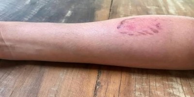 Jovem é agredido e mordido pelo padrasto: 'Me mordeu porque é soro positivo'