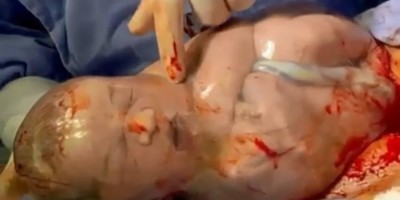 Bebê nasce sem estourar bolsa amniótica em Vilhena e vídeo viraliza na internet