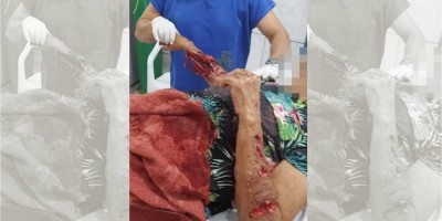 Idosa tem braços dilacerados após ataque de pitbulls em cidade de Rondônia
