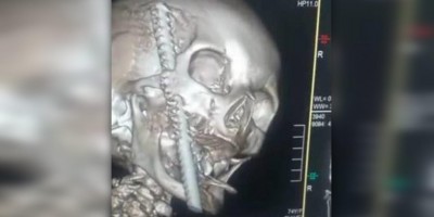 Vilhena: Vídeo em 3D mostra como vergalhão de ferro ficou alojado no rosto de idosa...