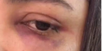 Técnica de enfermagem é espancada por marido que dormiu fora de casa