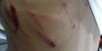 Menina de 14 anos vai parar na delegacia com arranhões e mordidas causados pela própria...