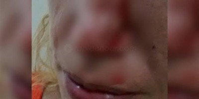 Esposa tem o nariz quebrado após ser agredida pelo marido embriagado