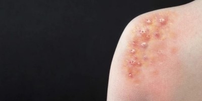 Ministério da Saúde investiga dois casos suspeitos de varíola do macaco em Rondônia;...