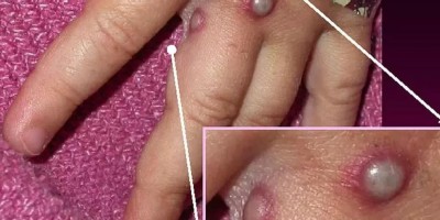 Casos suspeitos de varíola dos macacos em RO são descartados após exames