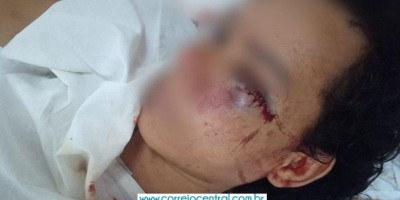 Mulher quase é morta a marteladas pelo marido em Ouro Preto