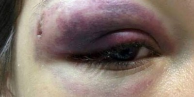 Mãe chama atenção do filho durante briga com irmão e leva pedrada no rosto