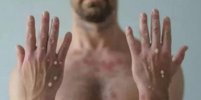 'Varíola dos macacos' já chega a quase mil casos no Brasil