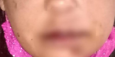 Mulher nega 'ir para cama' e tem nariz fraturado pelo marido