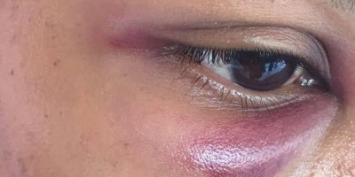 Marido é preso após agredir a esposa com socos no olho