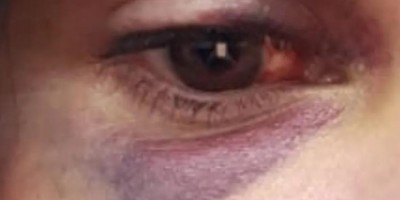 Jovem com medida protetiva é agredida com socos no olho
